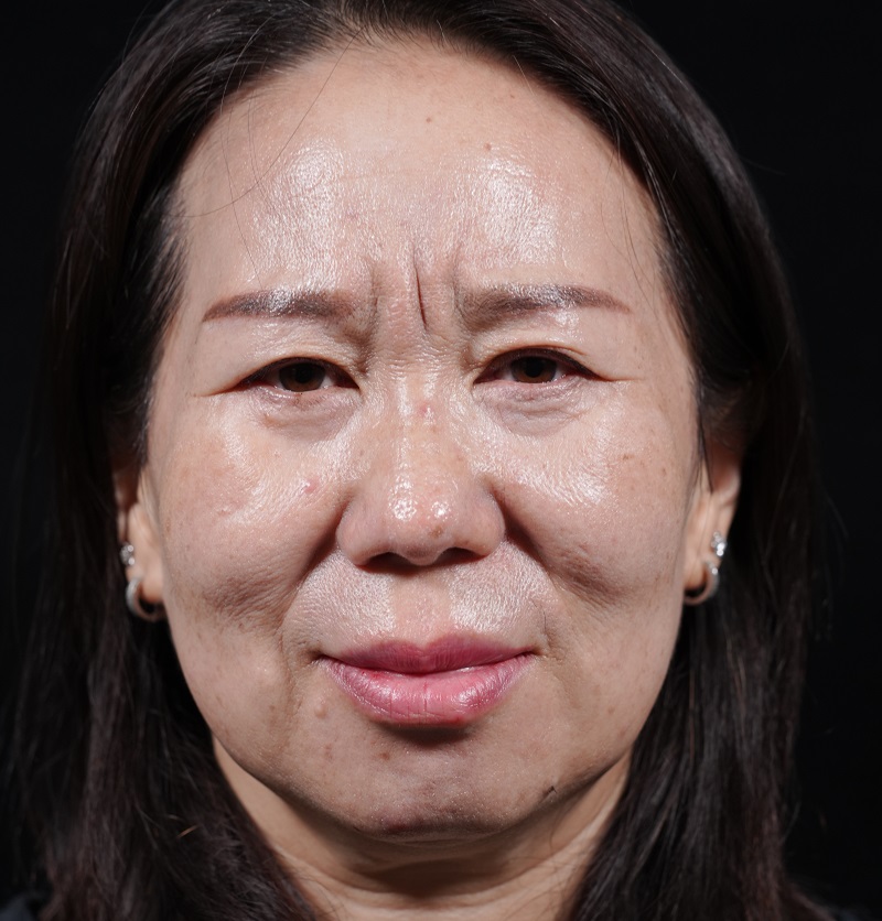 川字纹中间线是什么